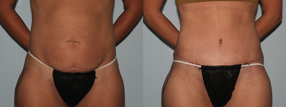 Tummy Tuck Patient Before & Afters