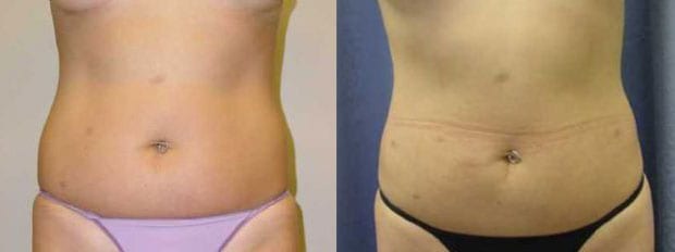 Liposuction Patient Before & After
